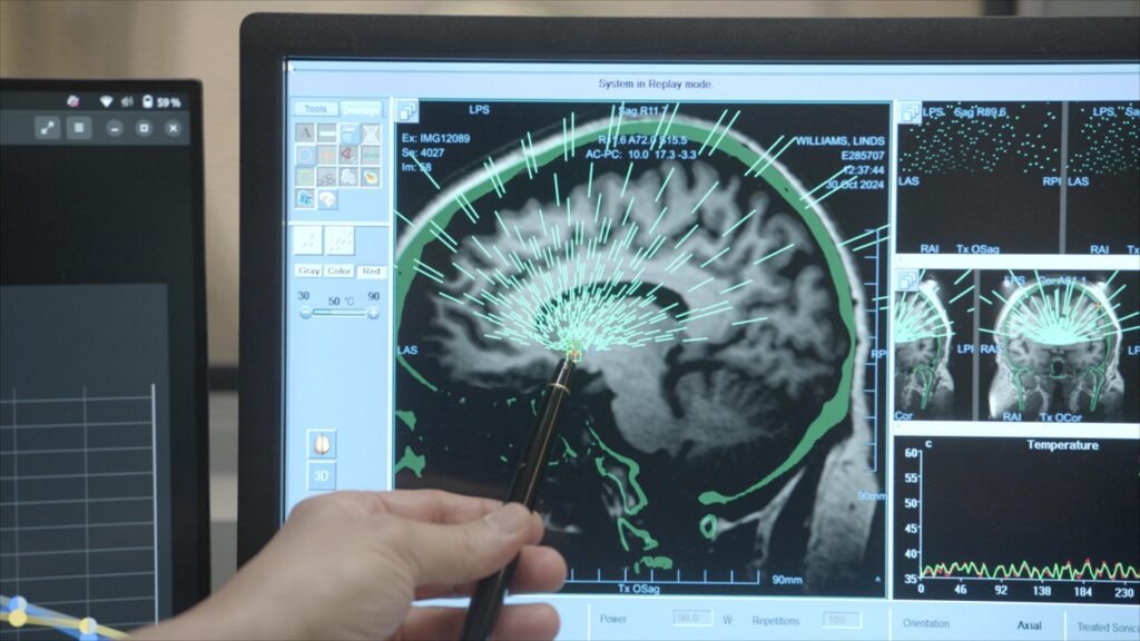 A hand holds a pen and points to a computer screen that displays a 3d ultrasound of a human brain.